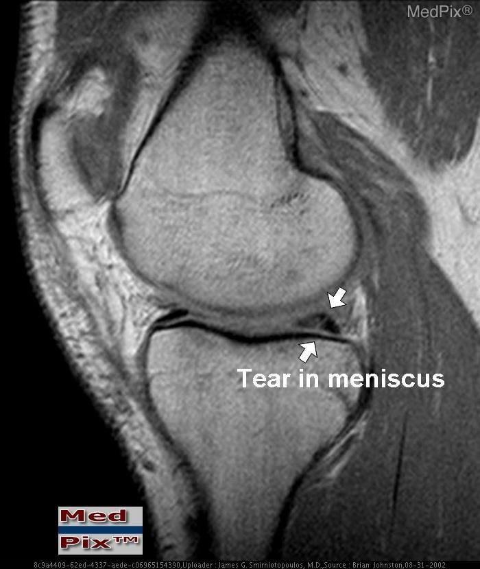 MRI scan of knee showing meniscus tear with arrow pointing to the damaged cartilage tissue